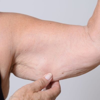 Why 99% of People Are Wrong About Saggy Arms: A Doctor Explains the Real Cause