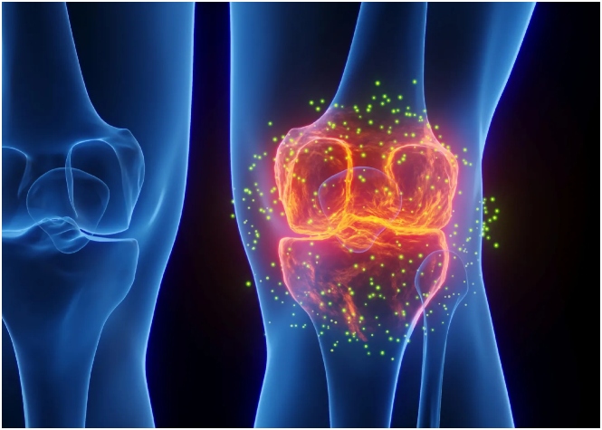 Arthritis bones